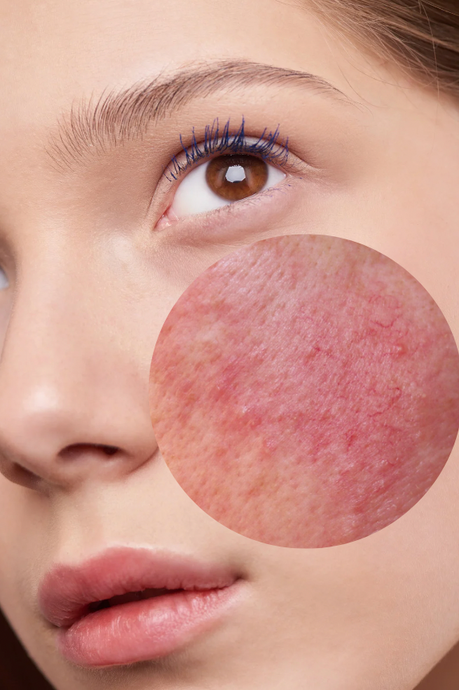 Hvilke produkter skal jeg bruge til rosacea?